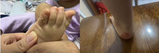 千元童鞋把脚穿肿？泰兰尼斯遭家长“围攻”，医生警惕影响发育，90%专利竟是外观设计